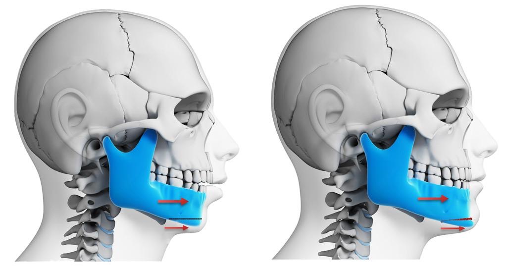 Surgical Orthodontics